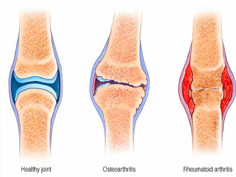 ARTHRITIS TREATMENT IN PATNA