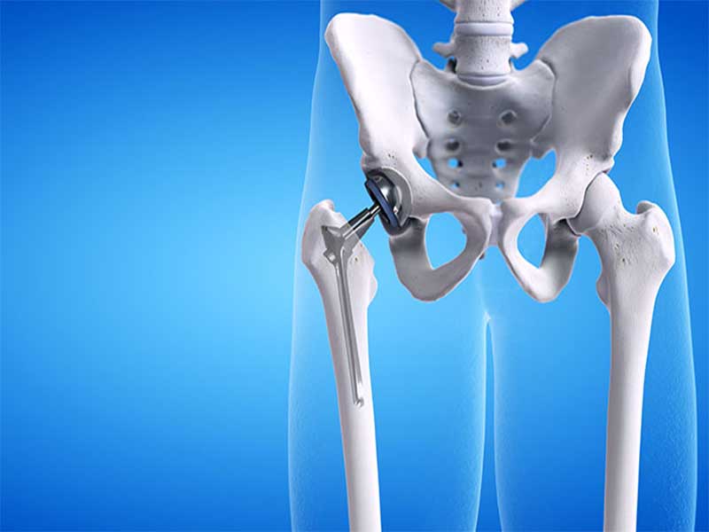 HIP REPLACEMENT SURGERY IN PATNA