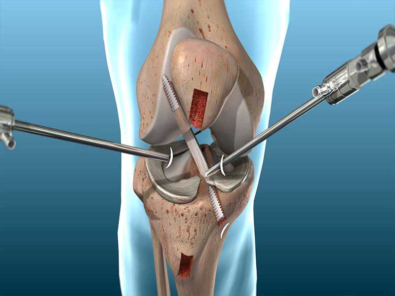 Ligament Surgery Specialist in Patna