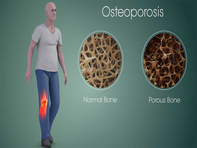 OSTEOPOROSIS TREATMENT IN PATNA